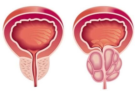The symptoms of prostatitis in men